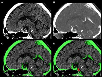 No Association Between Thrombus Perviousness and Cardioembolic Stroke Etiology in Basilar Artery Occlusion Stroke